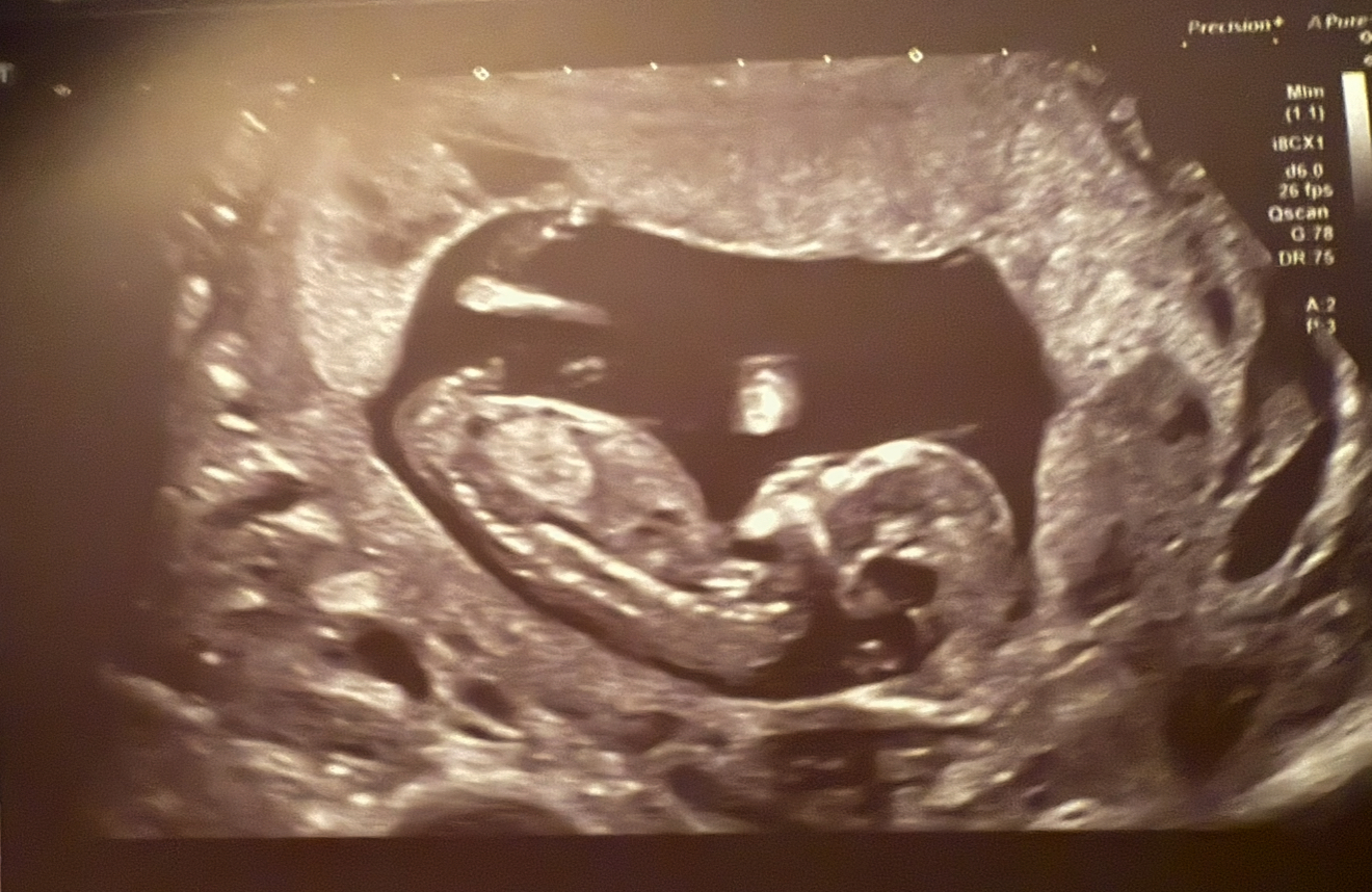Échographie de bébé Ace